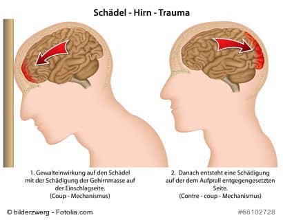 Schadelprellung Ursachen Symptome Behandlung