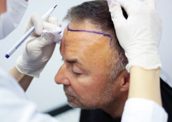 Beste Haartransplantation