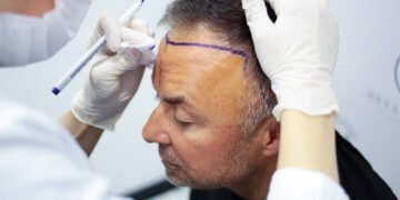 Beste Haartransplantation