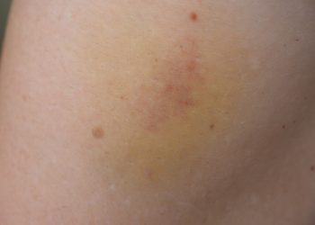 Bluterguss behandeln – wie kann die Heilung unterstützt werden?