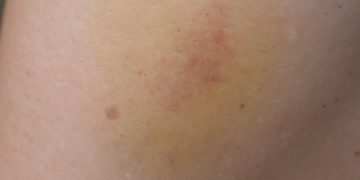 Bluterguss behandeln – wie kann die Heilung unterstützt werden?