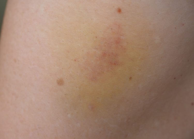 Bluterguss behandeln wie kann die Heilung unterstützt werden?