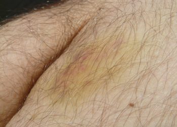 Bluterguss behandeln: Schnelle Hilfe und Ursachen von Hämatomen