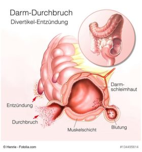 Ablauf beim Darmdurchbruch