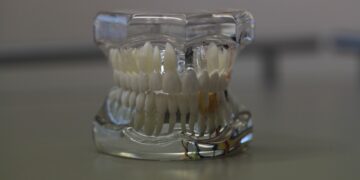 Fehlstellung der Zähne