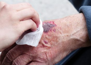 Infizierte Wunden – was tun, wenn eine Entzündung droht?