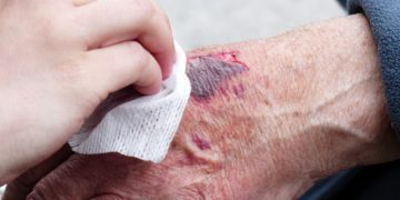 Infizierte Wunden – was tun, wenn eine Entzündung droht?