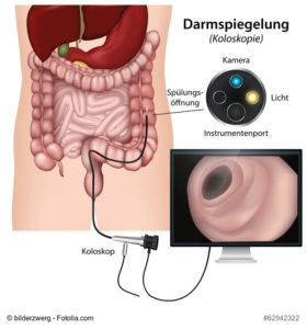 Ablauf einer Darmspiegelung