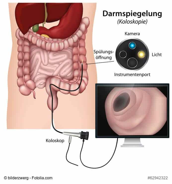 Darmspiegelung Ablauf einer Darmspiegelung