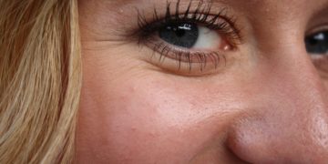 Krähenfüße-Behandlung: Effektives Entfernen von Krähenfüßen