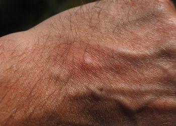 Mückenstiche – schnelle Gegenmittel im Überblick