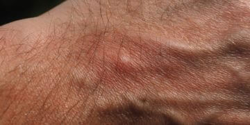 Mückenstiche – schnelle Gegenmittel im Überblick