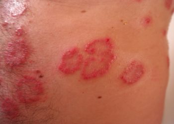 Ausschlag bei Kindern – so erkennen Sie die Ursachen und können Ihrem Baby schneller helfen!