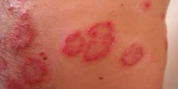 Ausschlag bei Kindern – so erkennen Sie die Ursachen und können Ihrem Baby schneller helfen!