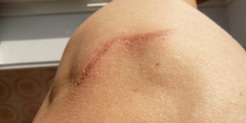 Narbenkorrektur: Methoden und Kostenübernahme durch die Krankenkasse