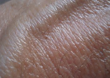 Hautkrebsscreening – wie läuft eine solche Untersuchung genau ab?