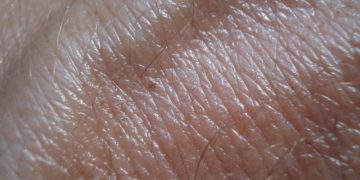 Hautkrebsscreening – wie läuft eine solche Untersuchung genau ab?