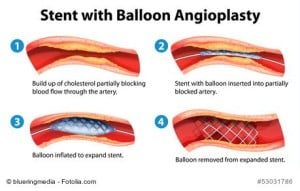 Stent setzen - Ablauf und Chancen einer Stent-Operation