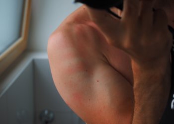 Tipps und Tricks gegen Sonnenbrand: Was ist dran?