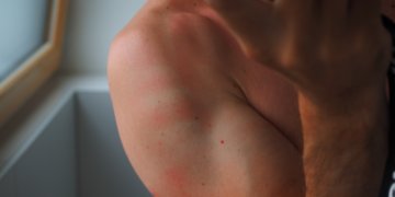 Tipps und Tricks gegen Sonnenbrand: Was ist dran?