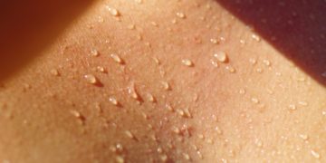 Schweißdrüsenabsaugung: Effektive Behandlung gegen Hyperhidrose
