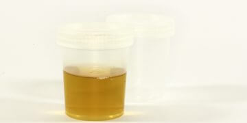 Brauner Urin – mögliche Ursachen und Gegenmaßnahmen