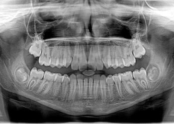 Ratgeber Zahnspangen